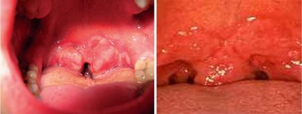 Angina angina pectorală, alopecia, leucoderma, leziunile mucoase ale gurii