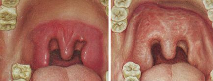 Angina angina pectorală, alopecia, leucoderma, leziunile mucoase ale gurii