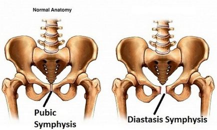 Simfizita în timpul sarcinii - simptome și tratament - sarcină