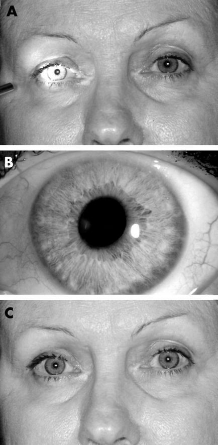 Sindromul Eidi (pupitru tonic, lipsa răspunsului pupilar la lumină) diagnostic, simptome