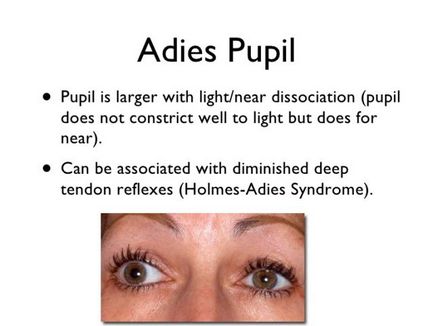 Синдром Ейді (тонічний зіницю, відсутність реакції зіниці на світло) діагностика, симптоми