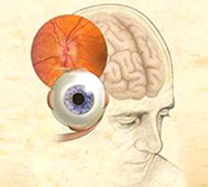 Sindromul Eidi (pupitru tonic, lipsa răspunsului pupilar la lumină) diagnostic, simptome