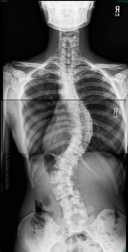 Scolioza tipurilor de simptome și efecte ale coloanei vertebrale