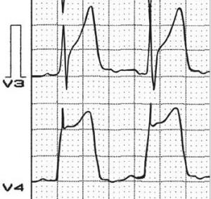 Angina pierzmetal principalele simptome și ecg-diagnostice