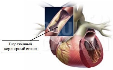 Stenocardia princemetal cauze, simptome, tratament, diagnostic, consecințe și prognoză