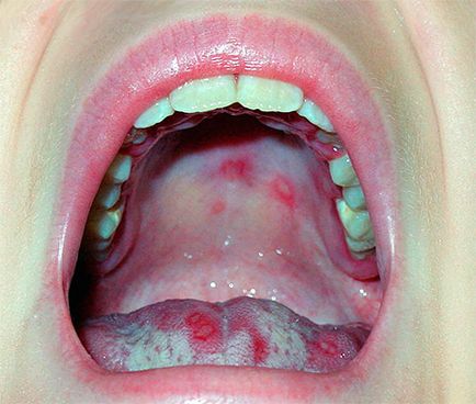 Stomatita in limba, sub limba adultilor, tratament, prevenire