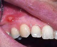 Manifestări dentare ale bolii de reflux gastroesofagian