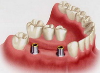 Стоматологія призма нижнекамск, штучні зуби