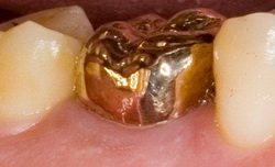 Стоматологія призма нижнекамск, штучні зуби
