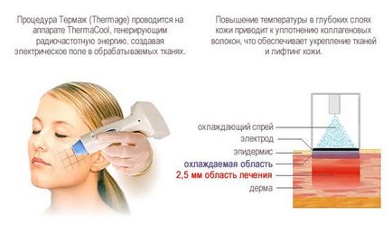 Thermage face recenzii de cosmeticieni, fotografii înainte și după