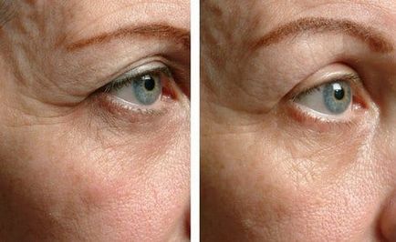 Thermage arc kozmetikusok véleménye, képek előtt és után (Thermage) Thermage arc kozmetikusok véleménye, fotók előtt és után
