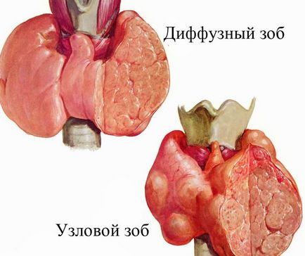 Thyreotoxikus adenoma a pajzsmirigy - jellemzői, a tünetek és a kezelés