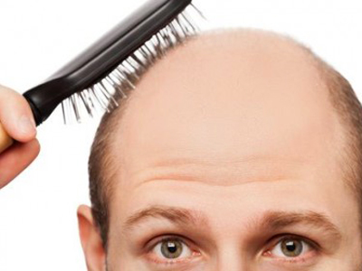 Oamenii de stiinta au dezvoltat un nou mod de a trata viata alopeciei - stiri - viata barbatilor