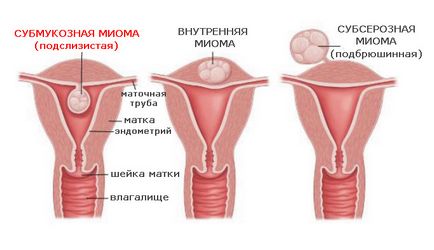 Eliminarea miomului uterin prin metoda laparoscopică sau prin operația cavitară