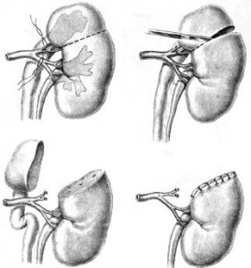 Duplicarea rinichilor - diagnostic și tratament