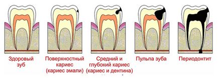 У дитини болить зуб - можливі причини і лікування