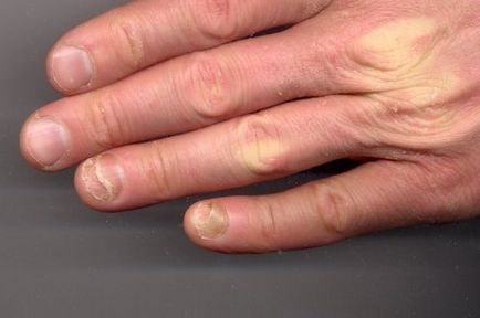 Уротропін від грибка нігтів при перших ознаках хвороби, красиві нігті - додаток твого образу