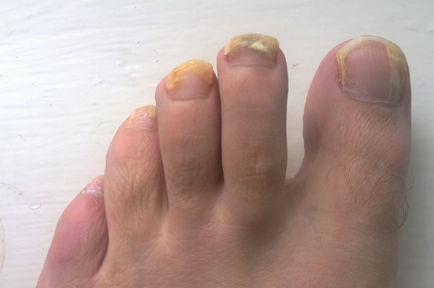 Уротропін від грибка нігтів при перших ознаках хвороби, красиві нігті - додаток твого образу
