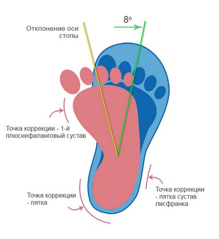 Varus, pantofi cu deformații varus ale piciorului, pantofi cu picior de picior