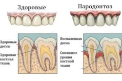 Вітаміни при пародонтозі