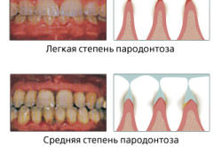 Vitaminok periodontitis (fogágybetegség) Vitaminok periodontitissel