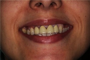 Inflamația gingiei din tratamentul protezei dentare