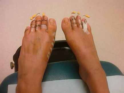 Chirurgia Cinderella - operație pentru a scurta degetele de la picioare
