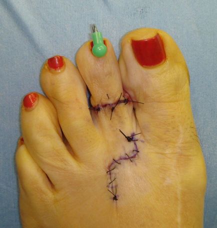 Хірургія попелюшки - операція з укорочення пальців ніг