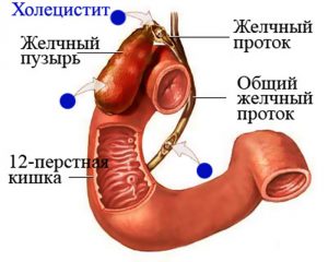 Холангит після видалення жовчного міхура