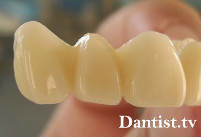 Зубні коронки з пластмаси на зуб ціна установки, догляд і фото