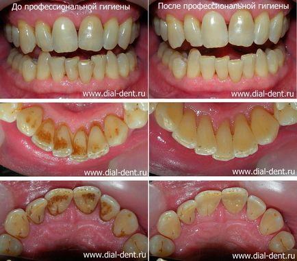 Зубний наліт курця - професійна чистка