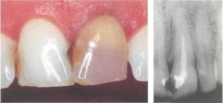 02 Cauzele discoloritelor