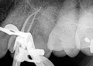 10 Factori pentru succesul tratamentului endodontic