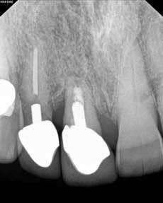 10 Factori pentru succesul tratamentului endodontic