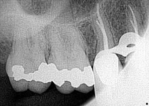 10 Factori pentru succesul tratamentului endodontic