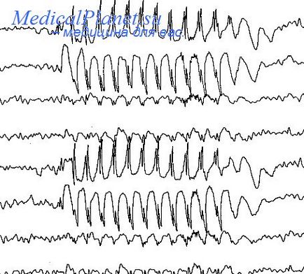 Epilepsie alergică-anafilactică