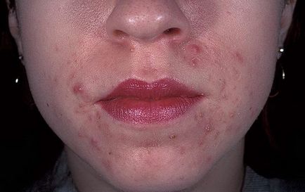 Алергія на крем для обличчя чому виникає і як від неї позбутися