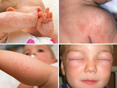 Алергія у дитини - пам'ятка для мами фото, онлайн-журнал - алергіка