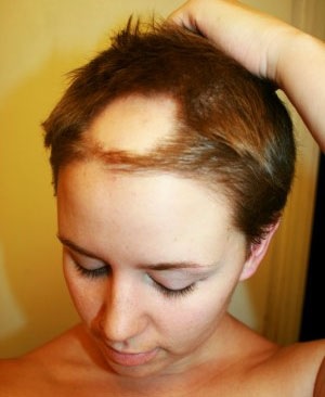 Alopecia areata la femei, bărbați și copii, cauzează tratament