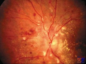 Angioscleroza retinei
