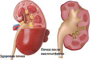 Antibiotikumok a hólyaghurut és pyelonephritis