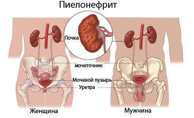 Антибіотики при пієлонефриті і циститі