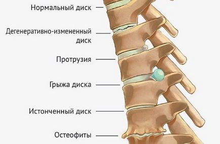 Osteoartrita coloanei vertebrale lombosacrale