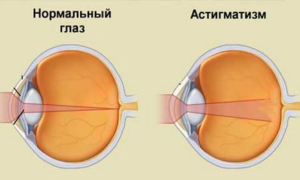 Astigmatismul la copii și tratamentul acestuia