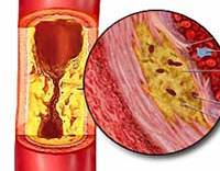 Ateroscleroza - cauze, simptome, diagnostic și tratament