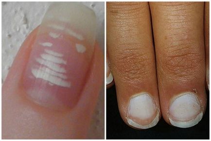 Білі смужки на ногтях- причини лейконіхіі, способи лікування