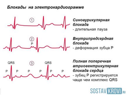 Blocarea inimii 1, 2, 3 grade, parțială, completă, la copil, cauzează tratament