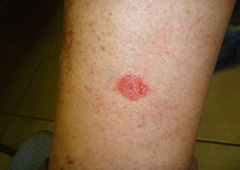 Eczema plăcii cum să trateze rănile umede și să ușureze inflamația