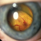 Boala de coat (retinita) - cauze, simptome si tratament