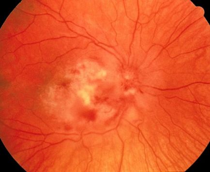 Хвороба Коатса (ретиніт) - симптоми, причини і лікування